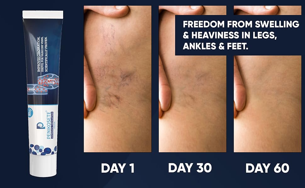 PENIKOSETE Cream Ayurvedic Solution For Management Of Varicose Veins, Spider Veins, Varicocele Reduces Cramps, Itching & Swelling. Buy 2 Get 1 Free (75 gms).