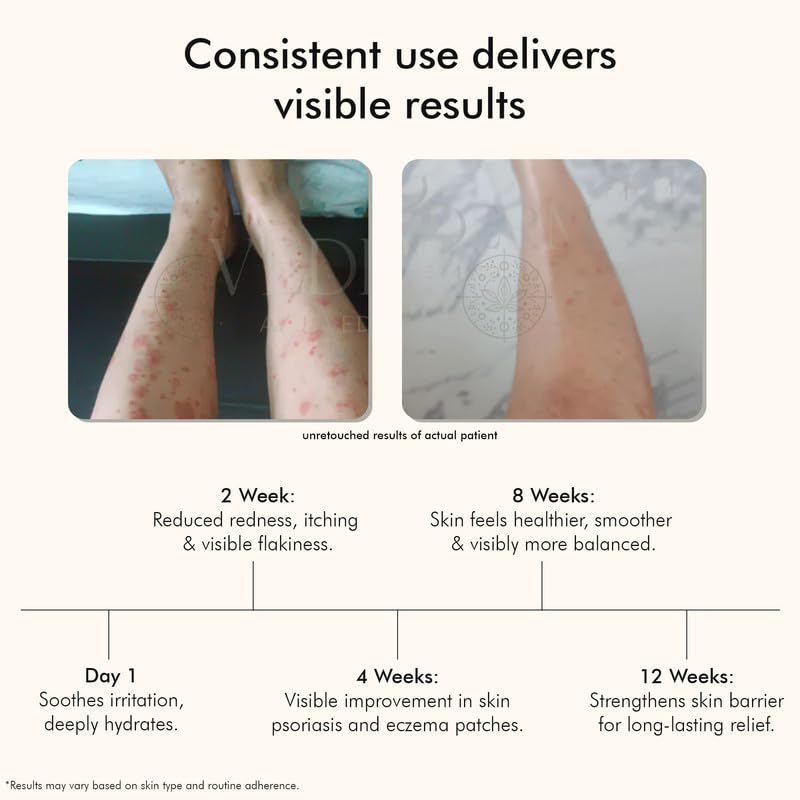 VEDICDERM Psoréa Cream with 2% Bakuchi Extract Skin Barrier Repair – view 5